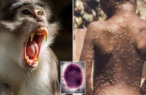 WHO મંકિપોક્સને જાહેર કરી શકે છે વૈશ્વિક સ્વાસ્થ્ય ઈમરજન્સી, 39 દેશોમાં નોંધાયા 1600 કેસ, બ્રિટનમાં સૌથી વધારે સંક્રમિત, 23મીએ ‘ઈમરજન્સી’ બેઠક!