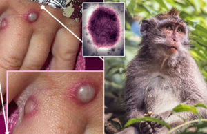 75 દેશમાં વ્યાપેલો મંકીપોક્સ ભારત પહોંચ્યો : દુનિયાભરમાં 11,000થી વધુ કેસ, અમેરિકાનાં 37 રાજ્યમાં મંકીપોક્સના નોંધાયા 750થી વધુ કેસ!