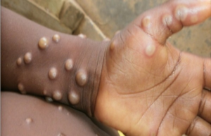 ભારતમાં મંકીપોક્સની એન્ટ્રી : કેરળમાં સામે આવ્યો શંકાસ્પદ કેસ, સંયુક્ત આરબ અમીરાતથી આવેલા એક પ્રવાસીમાં શંકાસ્પદ દેખાયા લક્ષણો!