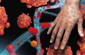 વિશ્વભરમાં મંકીપોક્સનો કહેર વધ્યો : દિલ્હીમાં બીજો કેસ, નાઈજીરિયન સંક્રમિત મળી આવ્યો; WHOએ મંકીપોક્સને લઈને આરોગ્ય કટોકટી જાહેર કરી!!